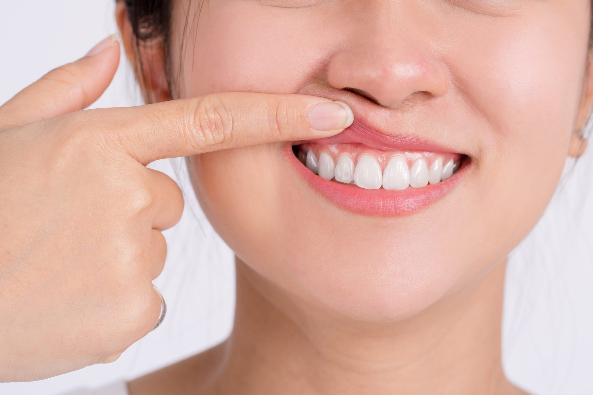 How Can You Avoid an Abscessed Tooth?