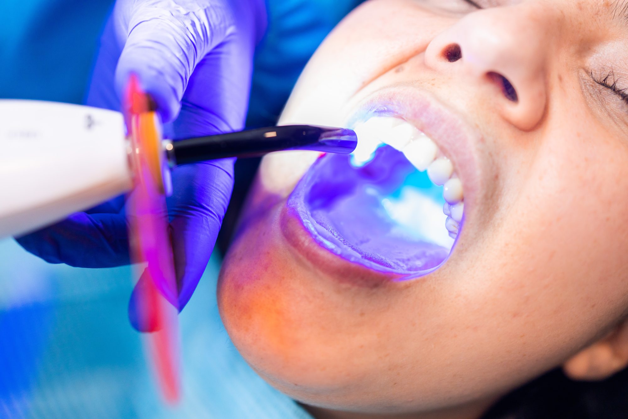 What to Expect From a Dental Bonding Process